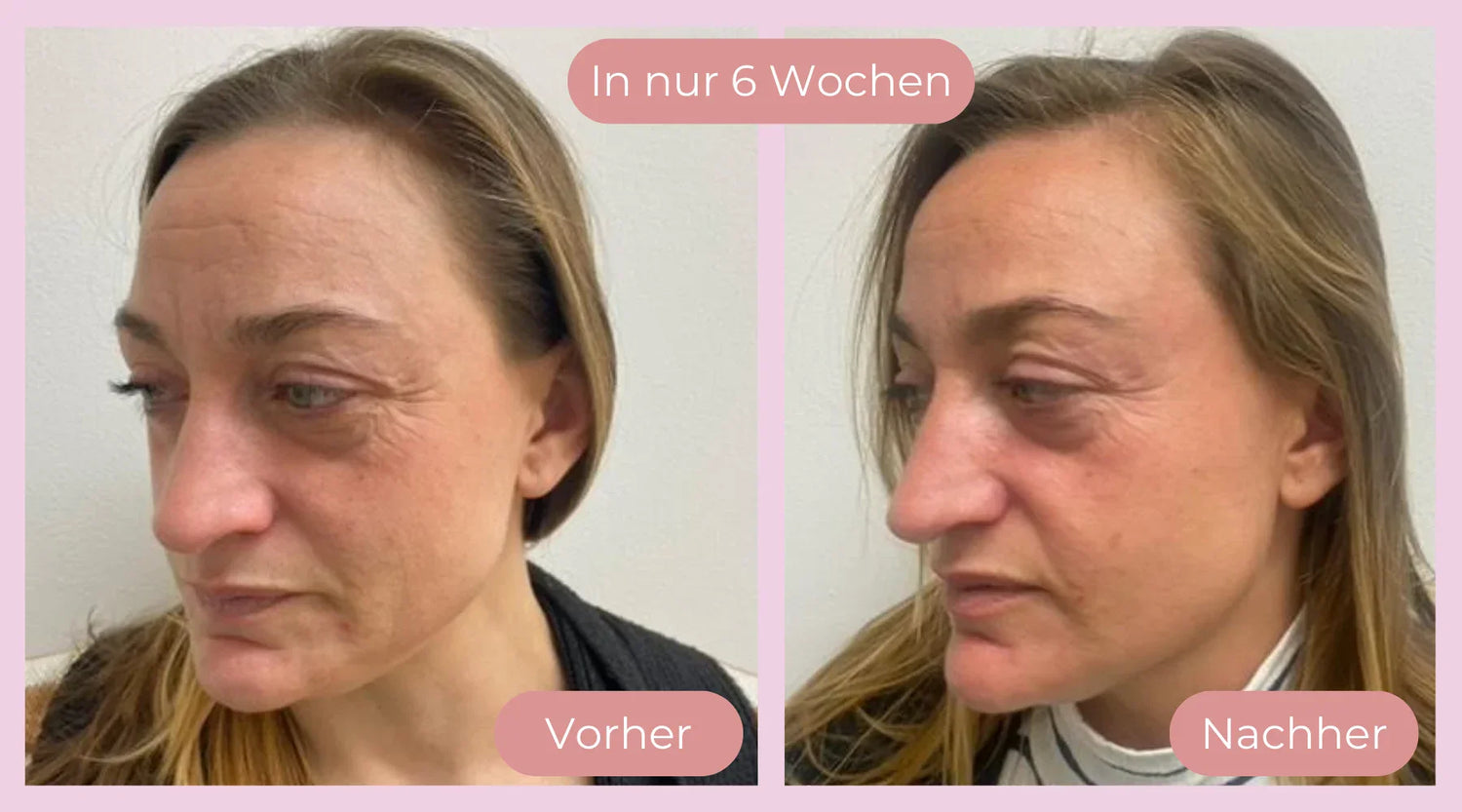 Strahlende Haut in 6 Wochen – Echte Vorher-Nachher-Ergebnisse mit Mandelbloom